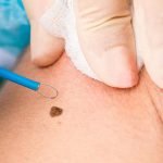 برداشتن خال