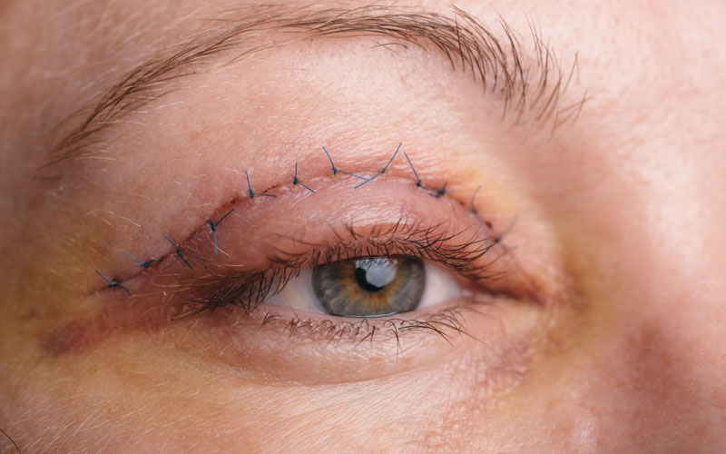 مقایسه بلفاروپلاستی و پلاسماتراپی