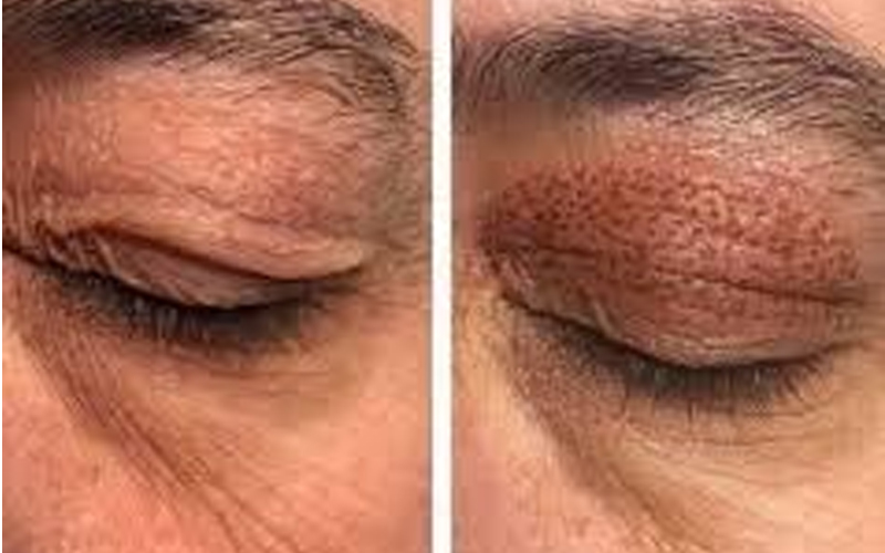 بلفاروپلاستی بدون جراحی