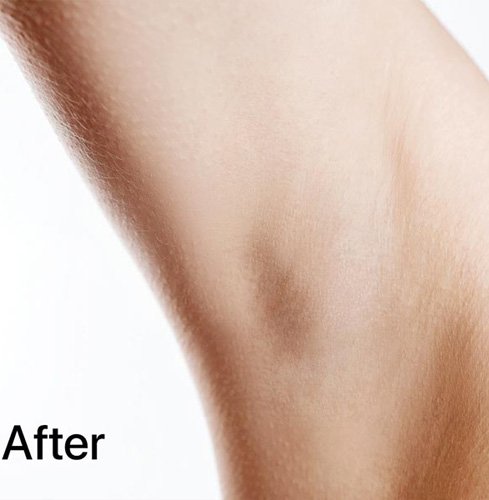 بعد از لیزر موهای زائد