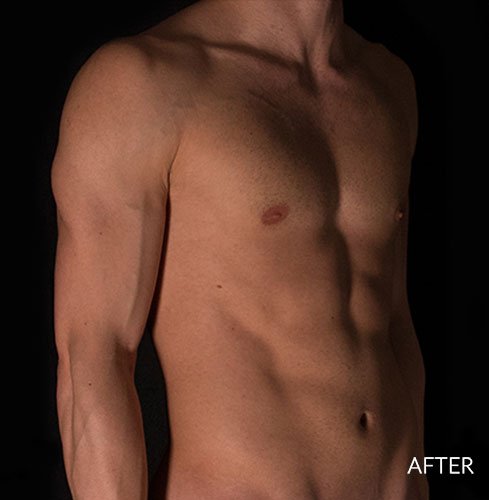 بعد ترواسکالپ