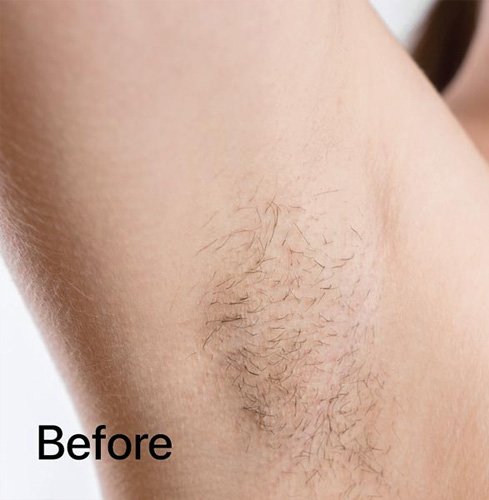 قبل از لیزر موهای زائد