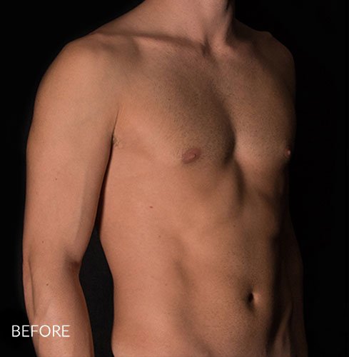 قبل ترواسکالپ