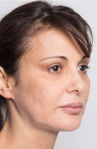 بعد از لیفت