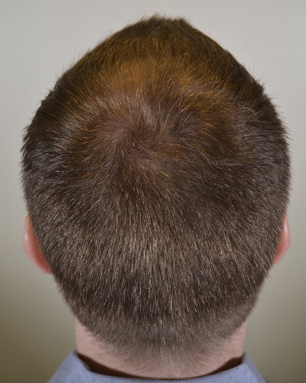 بعد از مزوتراپی