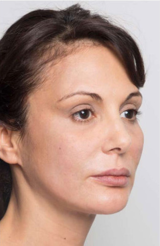 قبل از لیفت