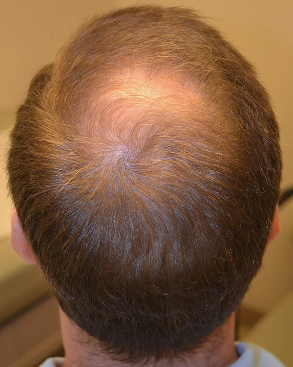 قبل از مزوتراپی