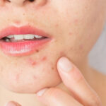 بررسی دلایل ایجاد آکنه