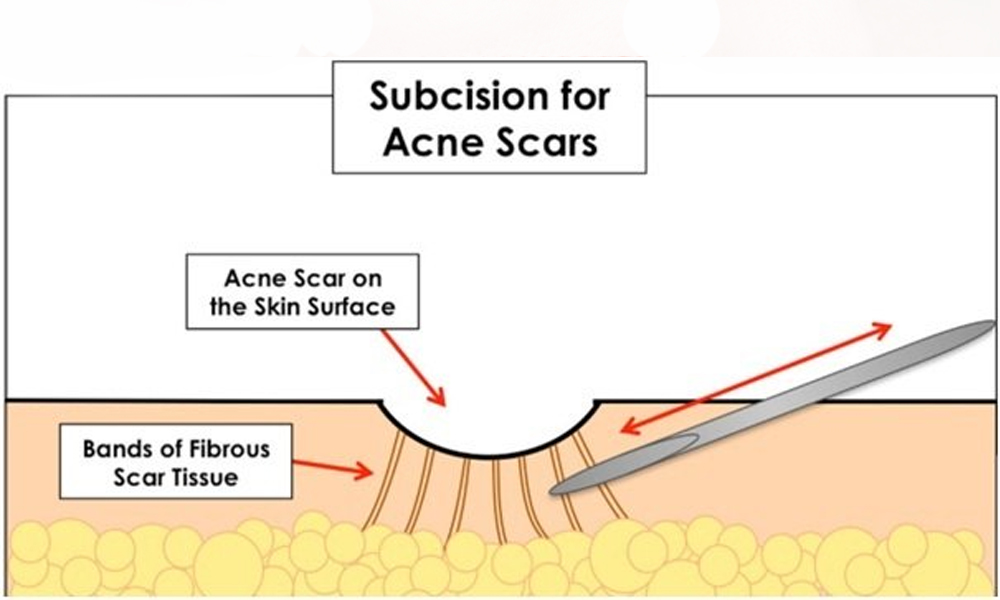 نحوه انجام سابسیژن