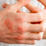 اگزمای پاییزی