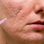 سابسیژن چگونه جای جوش را درمان میکند؟