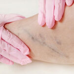 آیا ضایعات عروقی را می‌شناسید؟