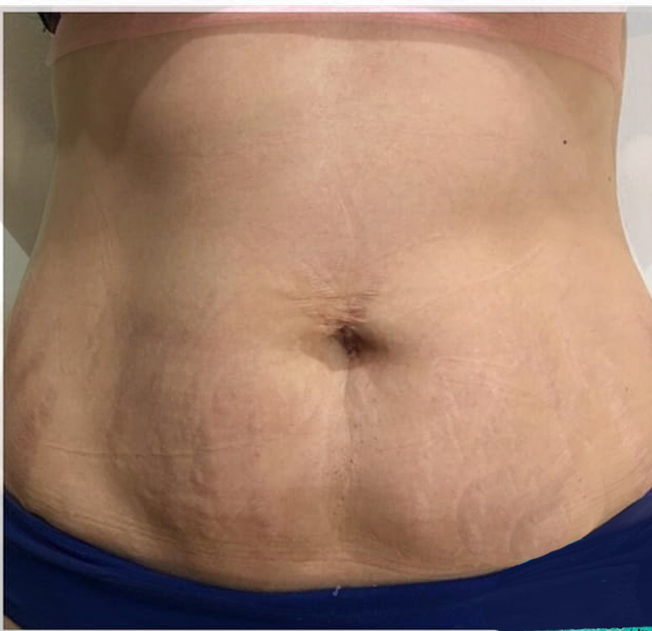 بعد از کویتیشن