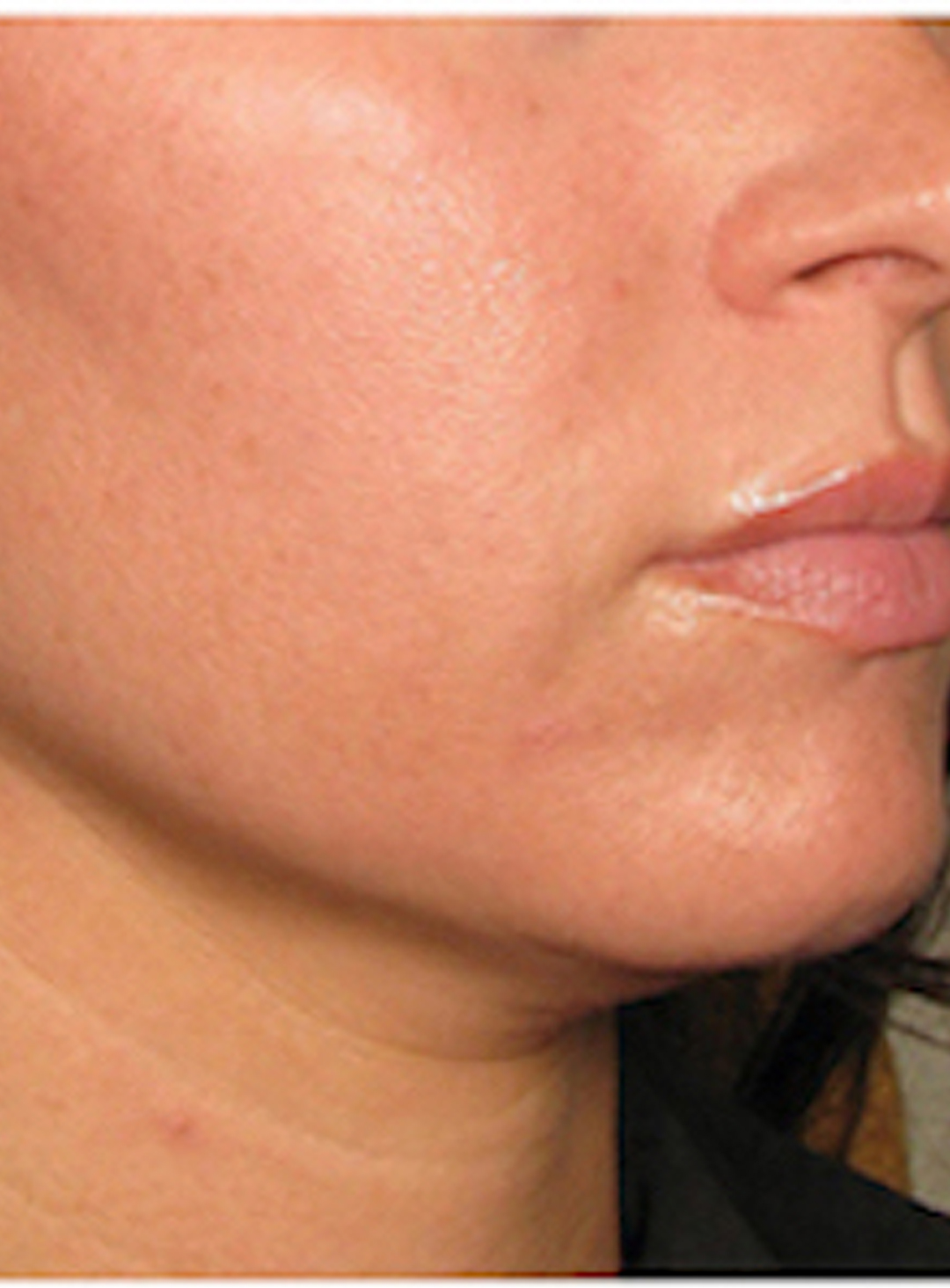 لیفت صورت بعد از هایفوتراپی