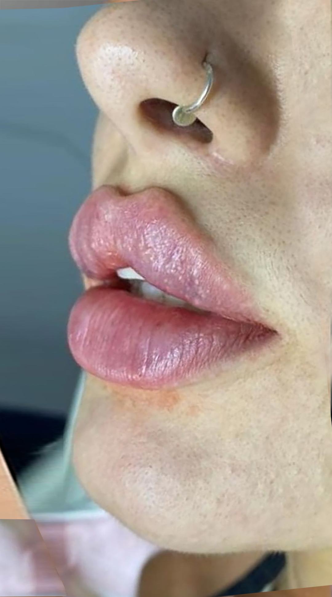 بعد از تزریق ژل