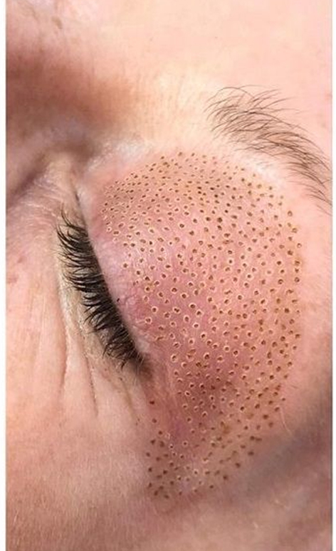 بعد از درمان افتادگی پلک با پلاسمیج