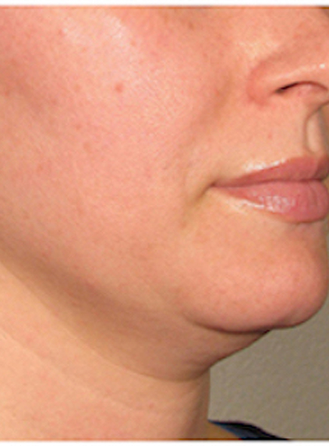 قبل از هایفوتراپی