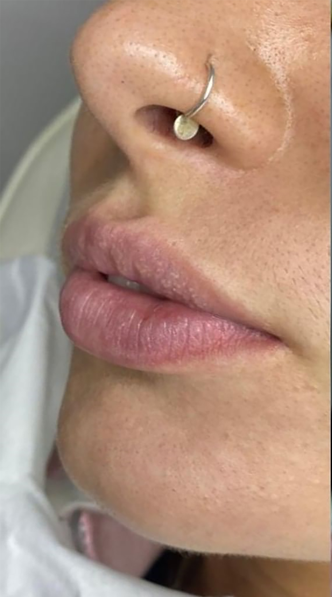 قبل از تزریق ژل