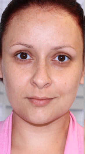 قبل از انجام میکرودرم