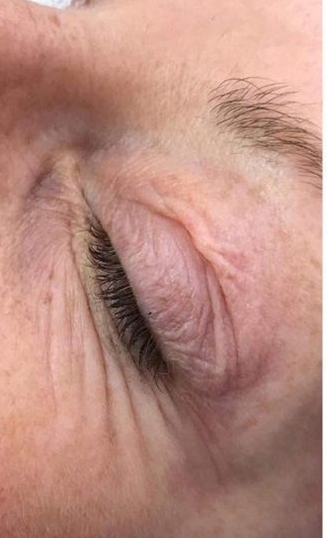 قبل از درمان افتادگی پلک با پلاسمیج