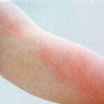 علائم پوستی جدید کرونا