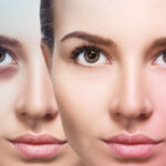 گودی و تیرگی دور چشم را چگونه درمان کنیم؟