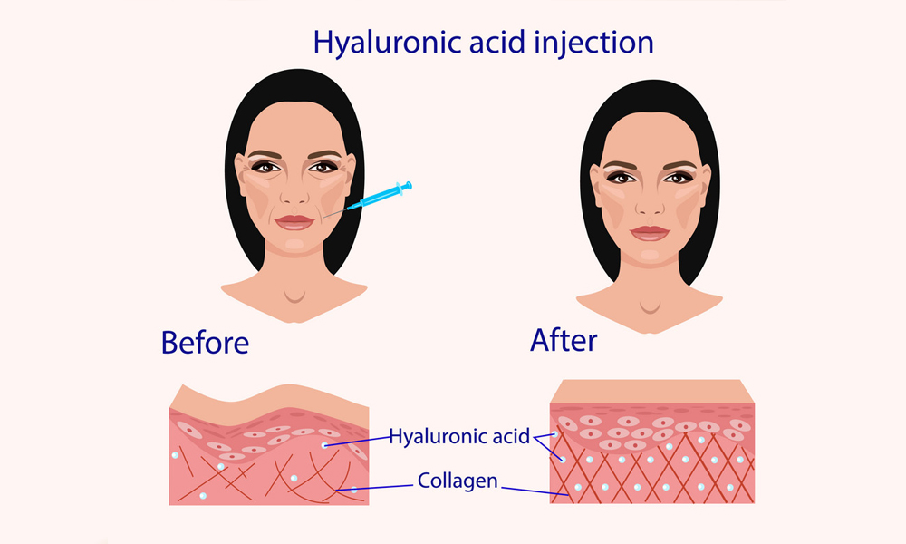 تاثیر هیالورونیک اسید