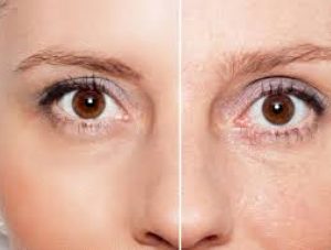 مزایای میکرونیدلینگ