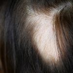 نتیجه مطالعه جدید: 22 درصد مبتلایان کرونا پس از 6 ماه دچار ریزش مو میشوند